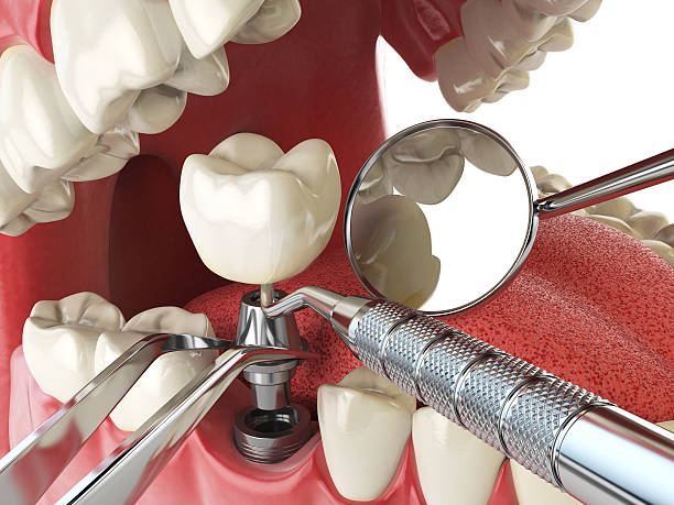 Best Emergency Root Canal Therapy in Struthers, OH